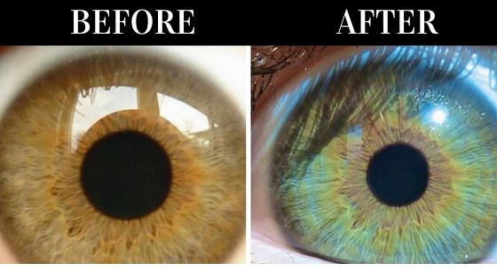 color-change-eye-surgery